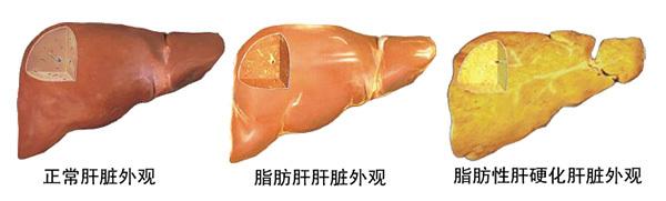 肝硬化