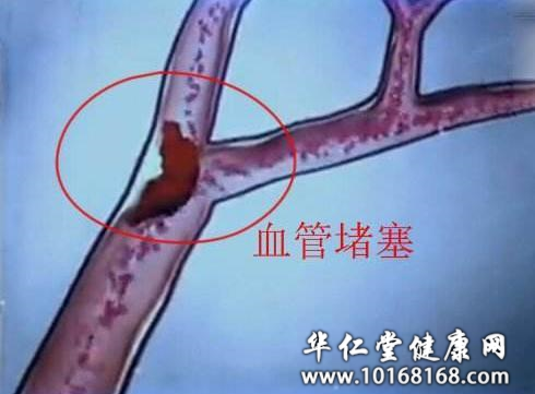 怎么样会血管堵塞.png