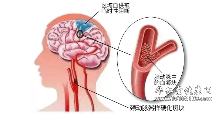 颈动脉硬化.png