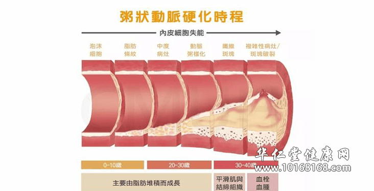 血管硬化.png