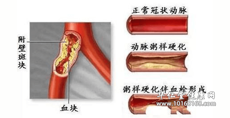 血管堵塞.png