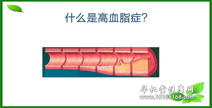 高血脂症